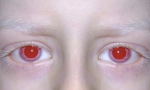 Reduced iris pigment