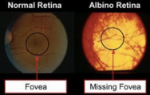 Hypoplastic Fovea