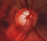 glaucoma retina